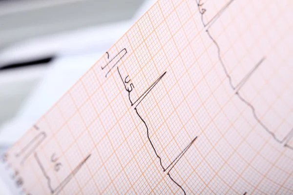 ECG complex op het papier — Stockfoto