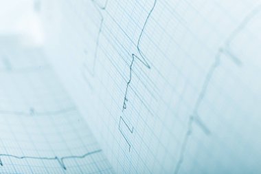 EKG kağıt kaydı, tıbbi geçmişi