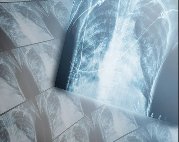 Heavy destructive changes in the lungs of the patients x-ray. — Stock Photo, Image