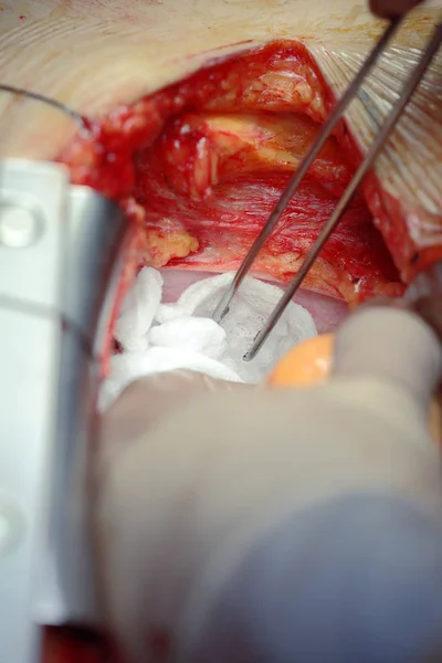 Руки хирурга с инструментом во время операции — стоковое фото