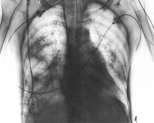 Examen radiographique d'un patient atteint d'une maladie pulmonaire — Photo