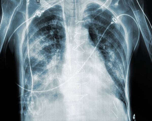 X-ray of patient after cardiac surgery
