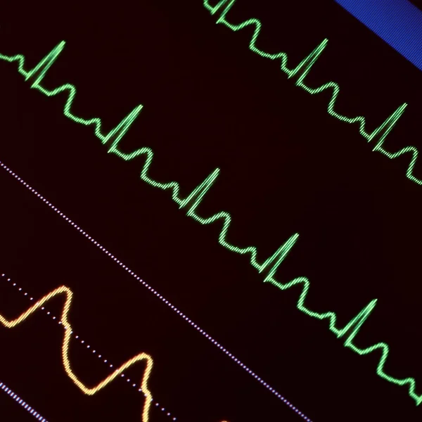 Heart monitoring in emergency care — Stock Photo, Image