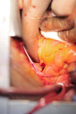 İş closeup cerrahi operasyonda