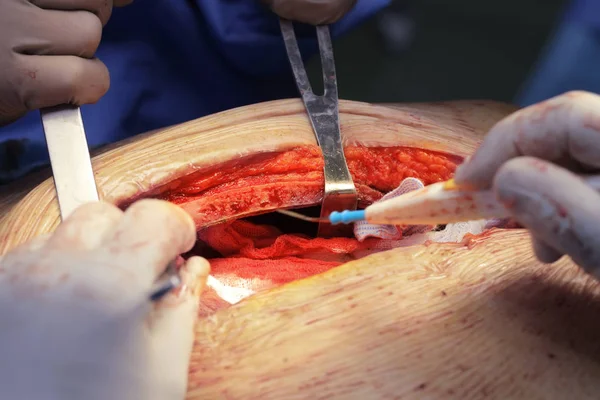 Торакальная хирургия в процессе — стоковое фото