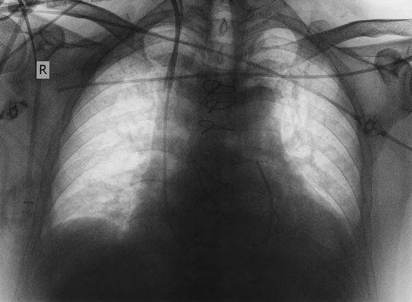 Image radiographique des poumons et du cœur — Photo