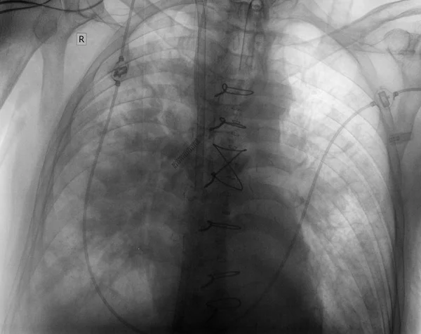 Imagem radiológica de um paciente com pneumonia — Fotografia de Stock