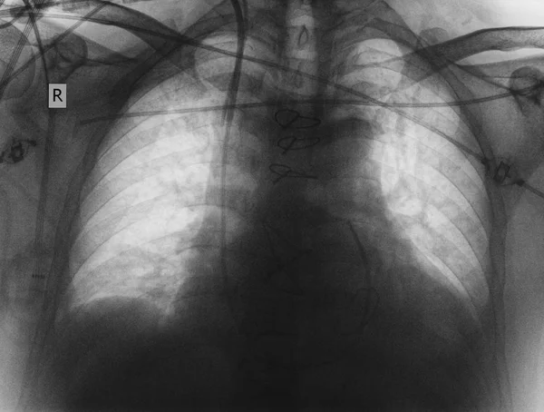 Image radiographique du patient après une chirurgie cardiaque — Photo