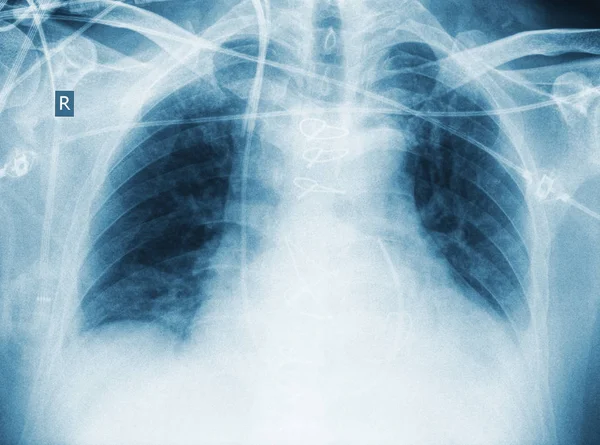 X-ray of patient after surgery with pneumonia — Stock Photo, Image