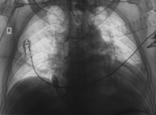 Рентгеновское обследование пациента после операции на сердце — стоковое фото