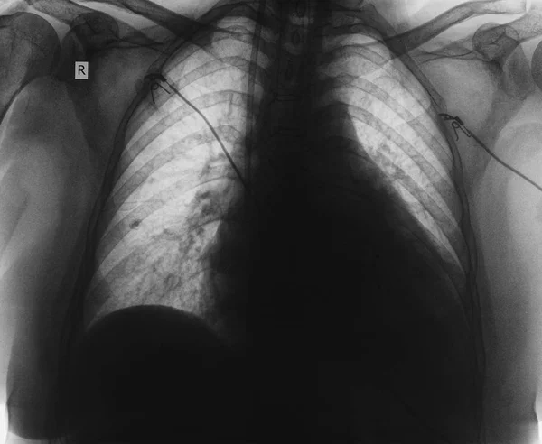 Icu 病人的伦形象 — 图库照片