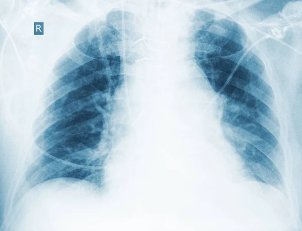 Radiologicznej kontroli hipostatycznej zapalenie płuc — Zdjęcie stockowe