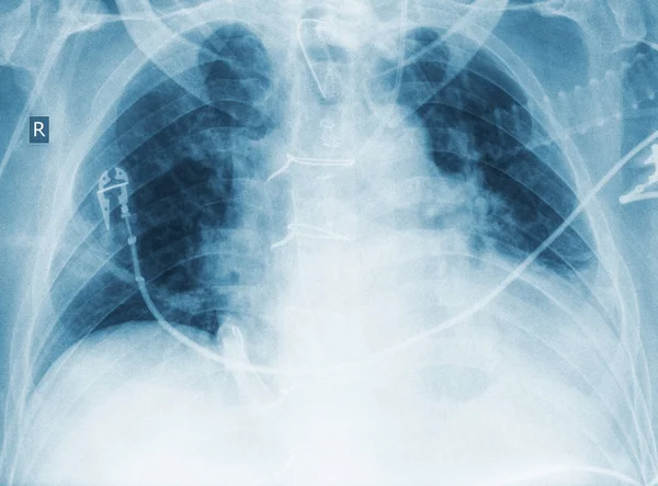 Рентгеновское изображение пациента с пневмонией — стоковое фото