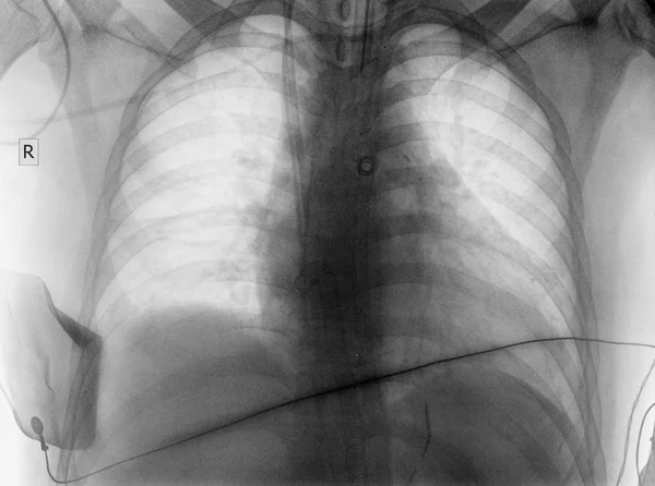 Röntgen Bild des Patienten in icu — Stockfoto