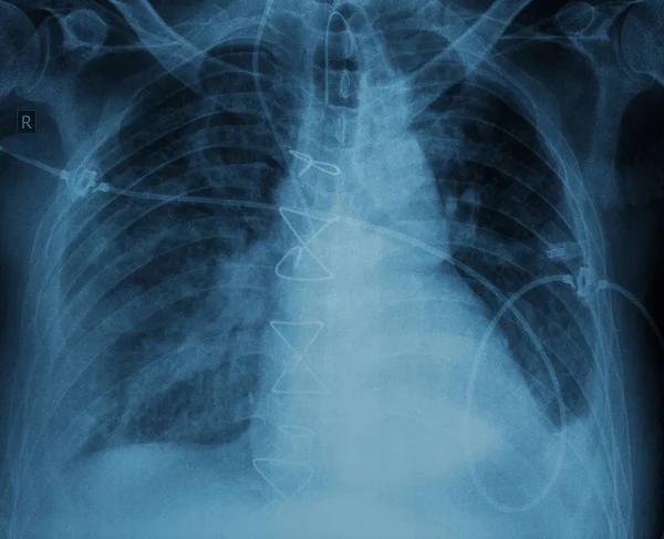 Después de la cirugía radiografía del paciente con sutura —  Fotos de Stock