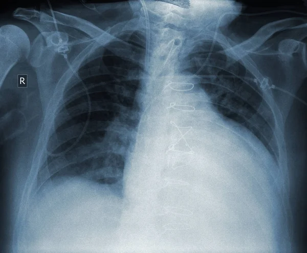 Radiographie du patient atteint d'une maladie cardiaque après une intervention chirurgicale — Photo