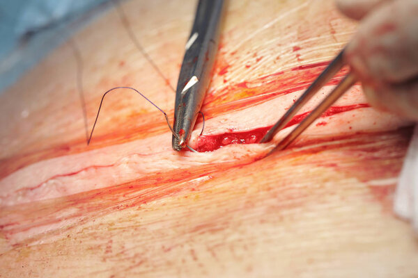 Process of suturing skin wound in hospital