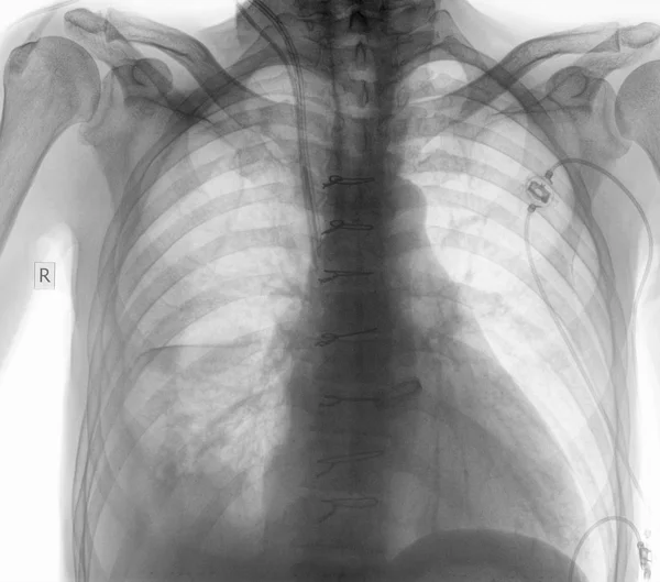 Радіограма пацієнта після хірургічної операції — стокове фото
