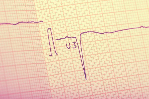 Risultati dell'ECG sul primo piano della carta — Foto Stock