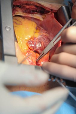 Kalp suturation cerrahi işlemi sırasında