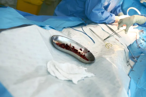 Οι θρόμβοι αίματος που αποβάλλεται από τα πλοία κατά τη διάρκεια της χειρουργικής επέμβασης — Φωτογραφία Αρχείου