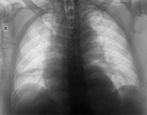 Radiographie thoracique simple du patient après une chirurgie cardiaque — Photo