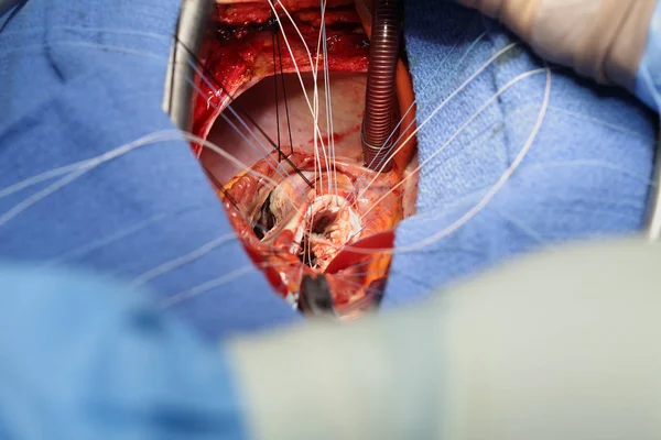 Process of open heart surgery — Stock Photo, Image