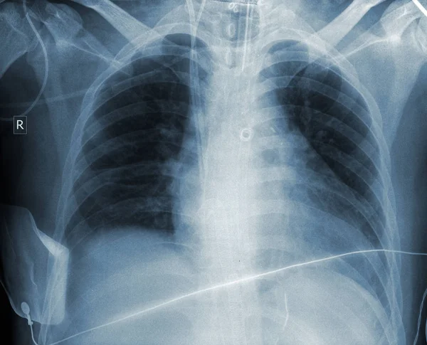 Resultado radiográfico del tórax del paciente —  Fotos de Stock
