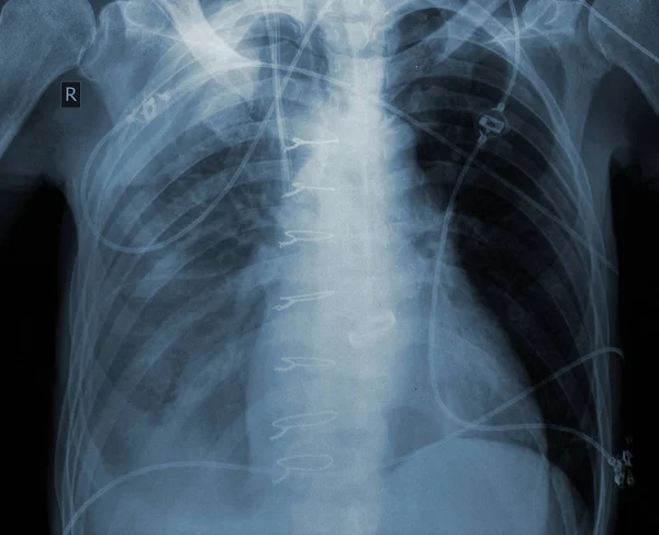 Egzamin X-ray pacjenta po operacji serca. — Zdjęcie stockowe