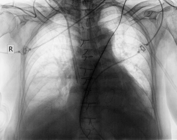 手术后病人的胸部平射线照相 — 图库照片