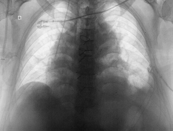 Радиограф органов грудной полости — стоковое фото