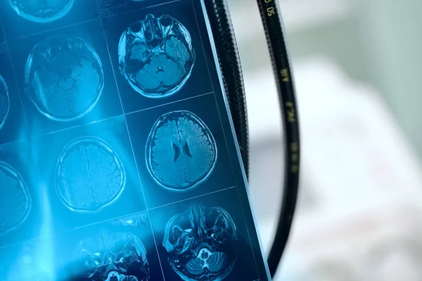 Imagem de RM na secção frontal do cérebro do doente — Fotografia de Stock