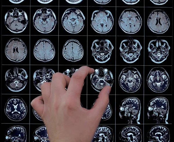 Doctor points with fingers to the head image on MRI — Stock Photo, Image