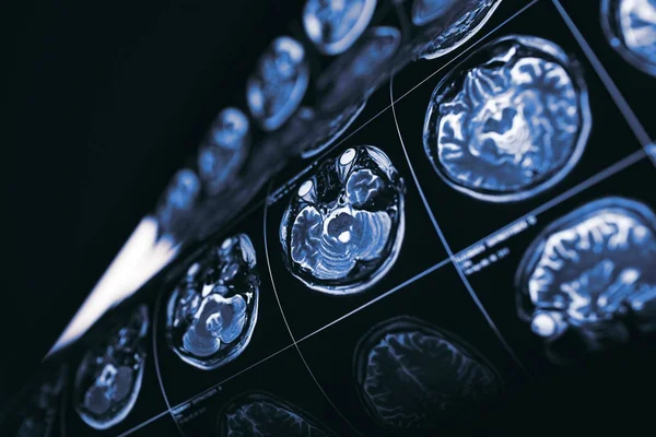 MRI of brain, concept of the mysteries of the human mind — Stock Photo, Image