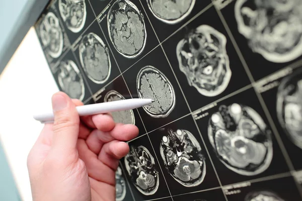 Arzt mit Stift auf dem MRI-Testergebnis — Stockfoto