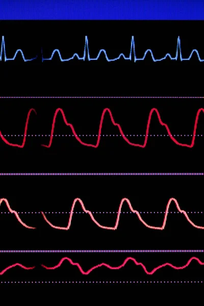Cardiograma no monitor de suporte de vida na unidade de terapia intensiva — Fotografia de Stock