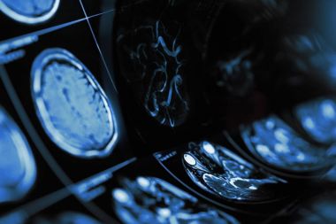 Şüpheli cerebro ile insan beyninin manyetik rezonans görüntüleme