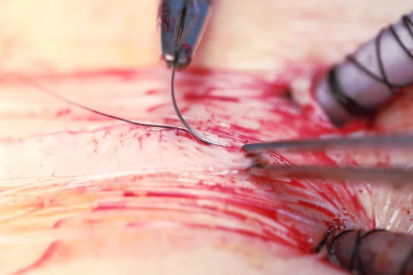 Agulha e pinças no processo de sutura de uma ferida no sk — Fotografia de Stock
