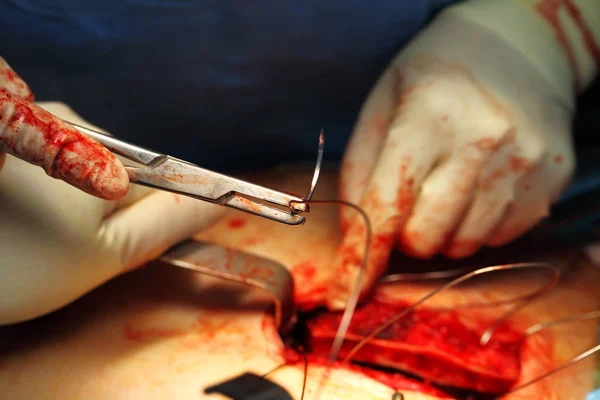 Heavy and real work of the surgeon, wound suture stage — Stock Photo, Image