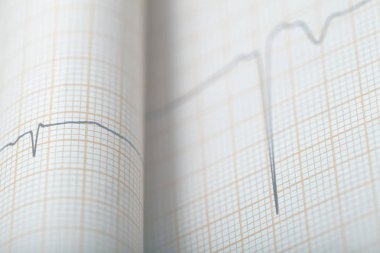 Kıvrık EKG grafiği, tıbbi geçmişi