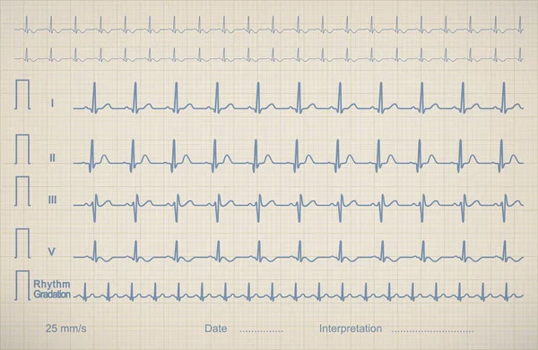 Obrázek grafu EKG pacienta lékařské, vektorové ilustrace. — Stockový vektor