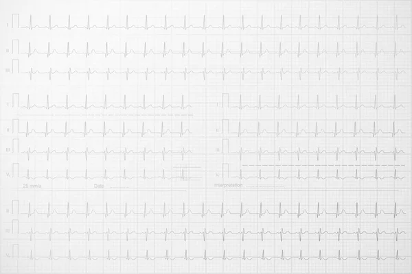 Kağıt arka plan, vektör çizim satırlarında EKG — Stok Vektör