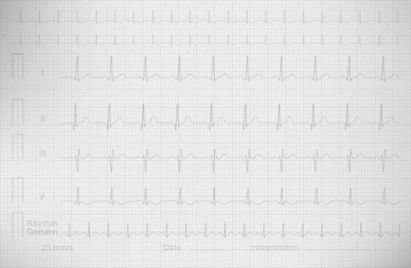 Ecg Zeichnung auf dem quadratischen Papier, Vektorbild — Stockvektor