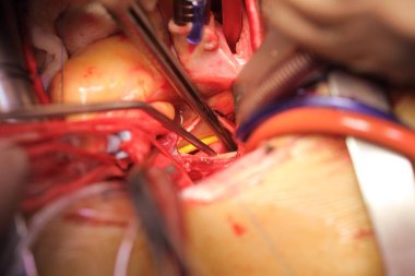 Açık kalp ile drenaj tüpleri ve aletleri içinde yakın çekim d