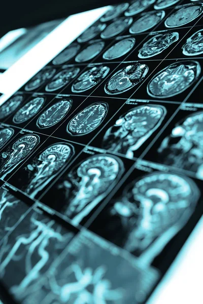Снимок МРТ крупным планом на коробке для обзора в больничной палате — стоковое фото