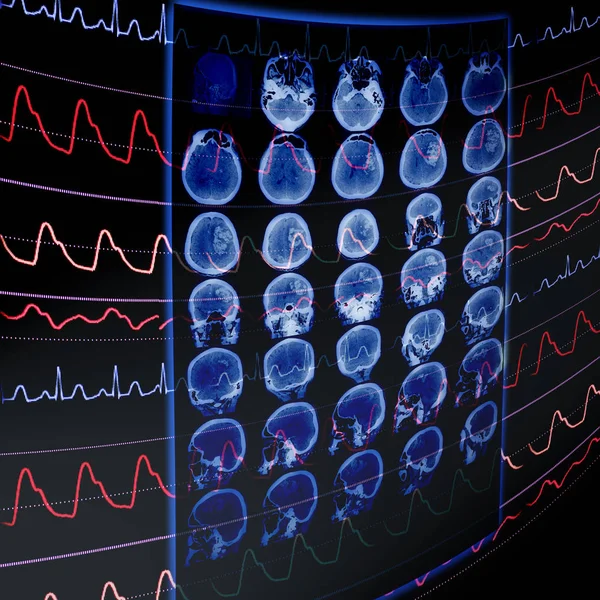 Monitoreo de tomografía computarizada y ECG como concepto médico de vascularización precoz — Foto de Stock