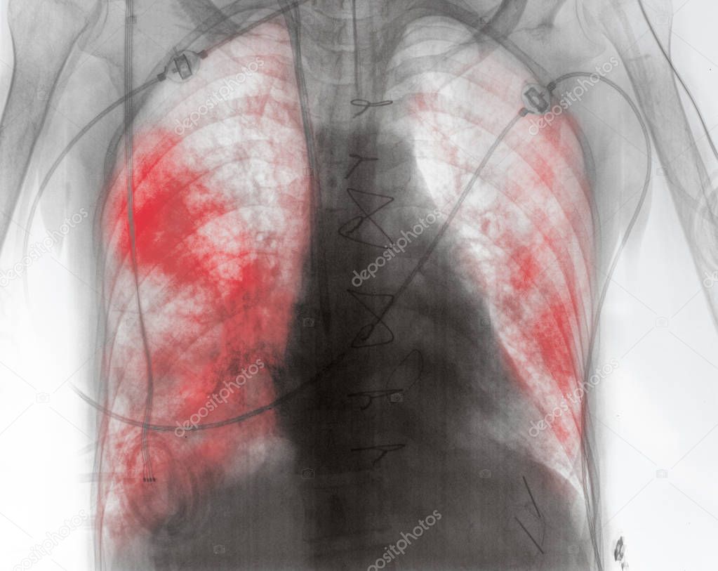 X-ray image of patient with lung inflammation in the early post-