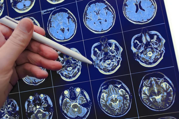 Médico señalando con pluma el poblem cerebral en la resonancia magnética — Foto de Stock