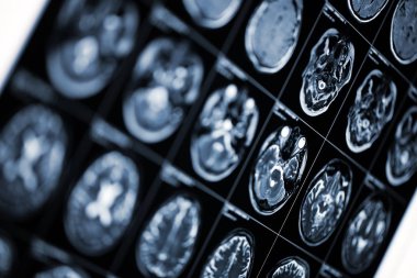 Tıbbi geçmişi ile MRI tarama görüntü insan kafası