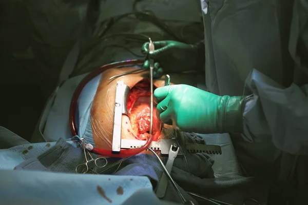 Surgery performing by surgeon on the open heart with connected t — Stock Photo, Image